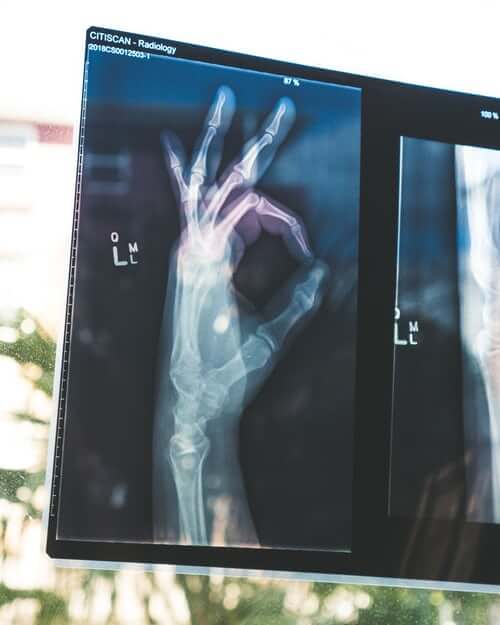x-ray hand OK